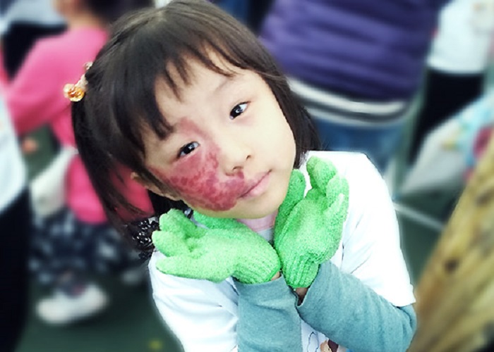 Little girl with facial birthmarks paints her dreams