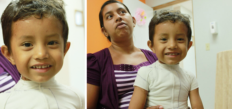 一年後，Josef的笑容依舊開朗，並穿著尼加拉瓜車縫師用新技術所製作的壓力上衣
