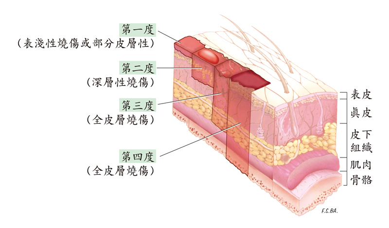 燒傷和其它病癥一樣,有輕微和嚴重之分,深度和面積是其程度判斷的依據