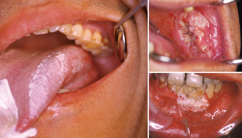 口腔出現了潰瘍、白斑、紅斑、以及紅白相間的紅白斑等，就要留意是否為癌前病變。