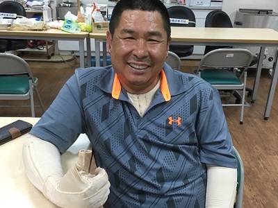 地表最強老爸 為女兒勇敢迎戰燒傷 -傷友 永崎大哥