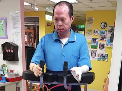 我的生活失火了！ - 燒傷傷友阿牛與姊姊的故事