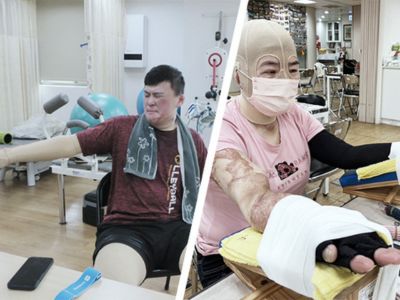 因「燒傷」而活出勇敢人生